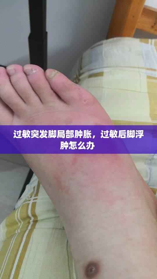 过敏突发脚局部肿胀,过敏后脚浮肿怎么办